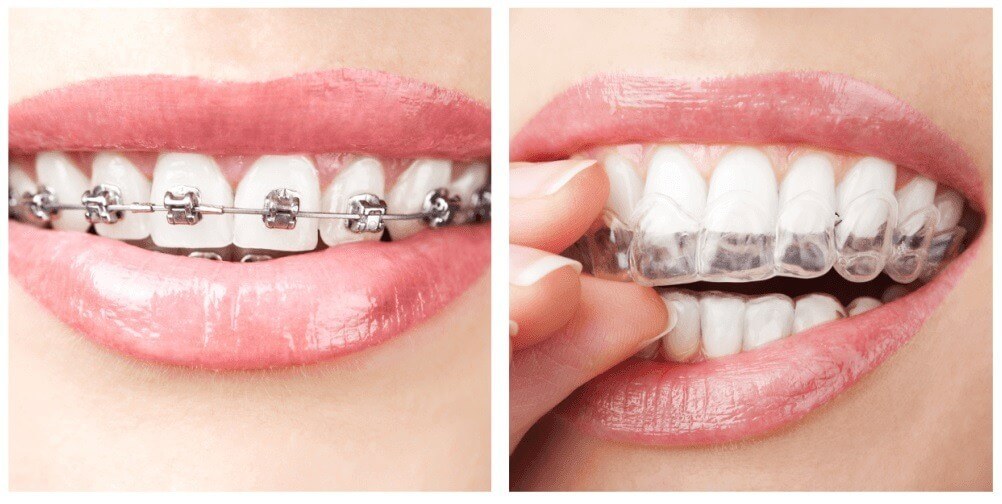 Braces vs Aligner, Which One is Better? - Bali Implant Aesthetic
